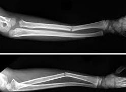 Recuperare după fracturi: rolul kinetoterapiei